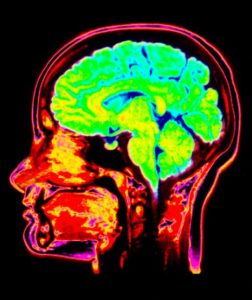 MRI scan of the head showing the brain highlighted in green